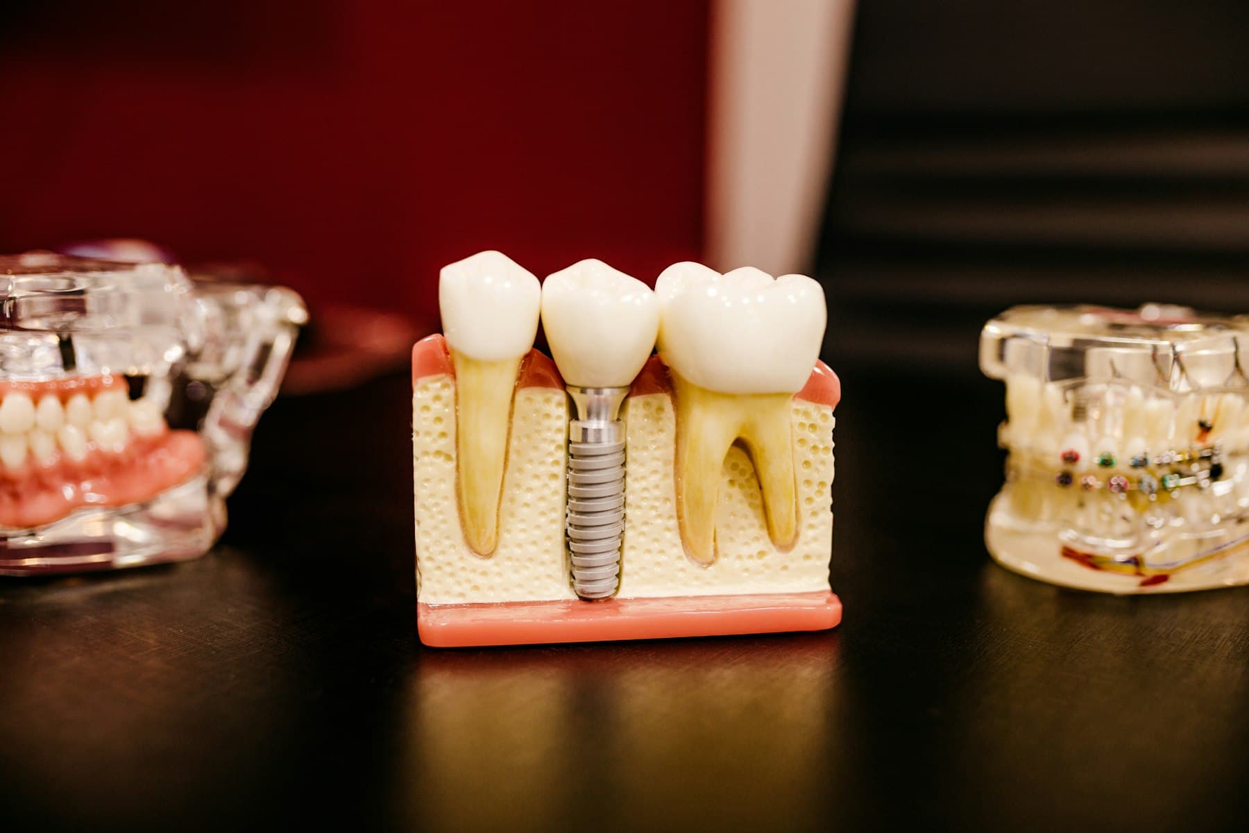 Diş implantını gösteren eğitim modeli